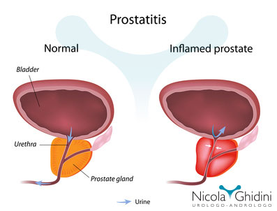 Rețetă de turmeric vs. Prostatită