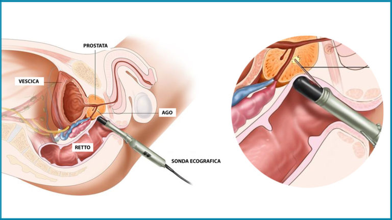 ecografia prostata transrettale