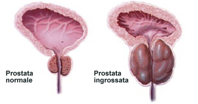 prostata ingrossata intervento chirurgico