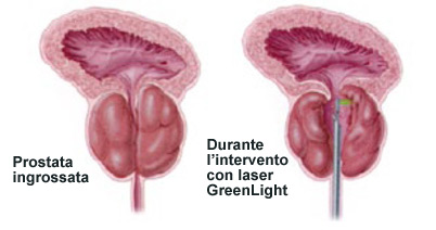 Prostata ingrossata e prostata durante l’intervento con laser GreenLight