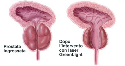 Prostata ingrossata e prostata dopo l’intervento con laser GreenLight