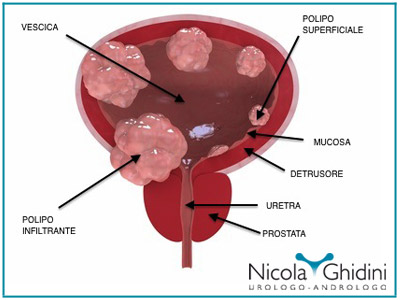 tumore vescica nicola ghidini