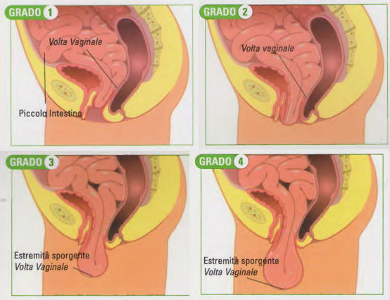 enterocele