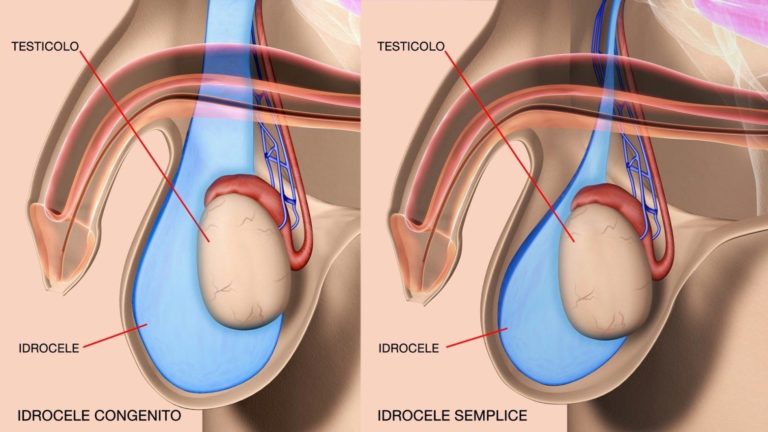 idrocele