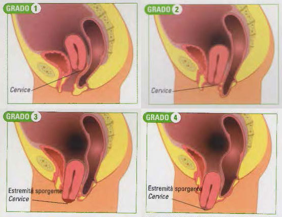 prolasso utero
