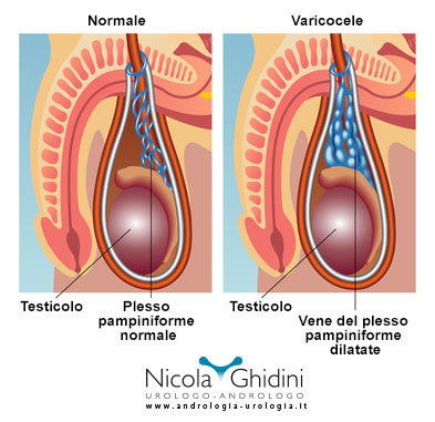 Varicocele