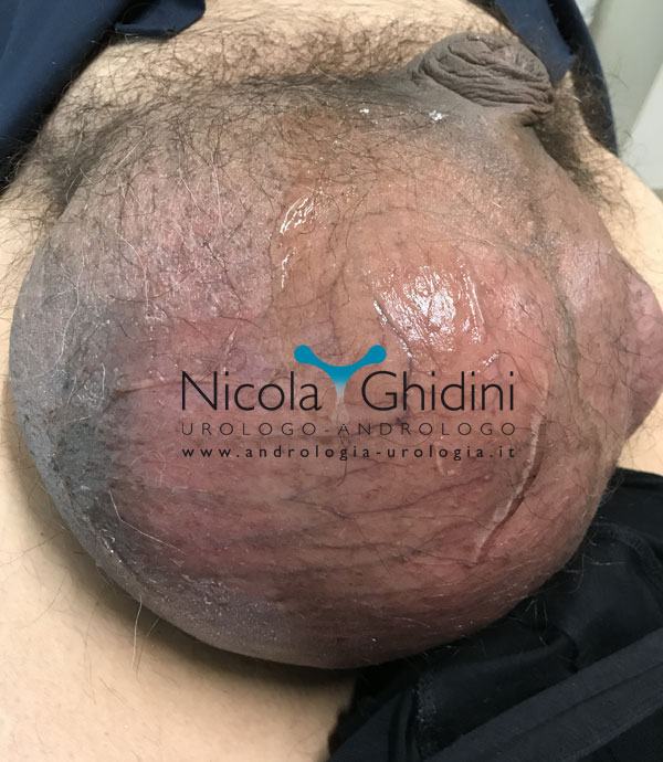 idrocele dott nicola ghidini