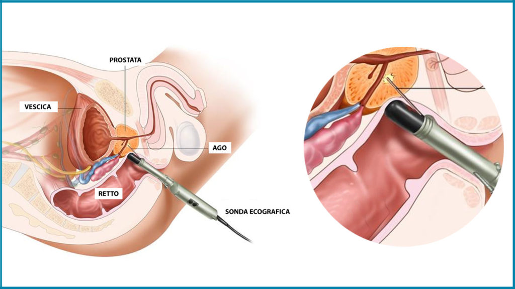 biopsia prostatica nicola ghidini urologo